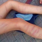 बेरहम - बेरहम टीचर: कक्षा दो के छात्र को गिनकर मारे 105 डंडे, पैरों और शरीर पर गहरे चोट के निशान; देखकर कांप गए घरवाले