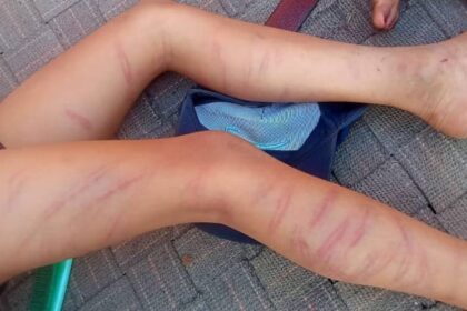 बेरहम - बेरहम टीचर: कक्षा दो के छात्र को गिनकर मारे 105 डंडे, पैरों और शरीर पर गहरे चोट के निशान; देखकर कांप गए घरवाले