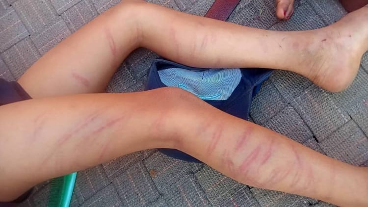 बेरहम - बेरहम टीचर: कक्षा दो के छात्र को गिनकर मारे 105 डंडे, पैरों और शरीर पर गहरे चोट के निशान; देखकर कांप गए घरवाले