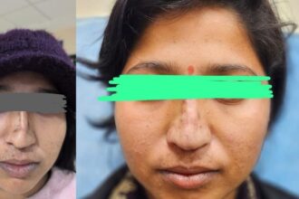 UP: जन्मजात - UP: जन्मजात टेढ़ी और चपटी थी नाक, एसएन के चिकित्सकों ने कर दिया कमाल; चार घंटे की सर्जरी से बदली जिंदगी