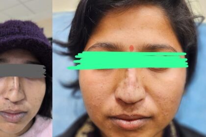 UP: जन्मजात - UP: जन्मजात टेढ़ी और चपटी थी नाक, एसएन के चिकित्सकों ने कर दिया कमाल; चार घंटे की सर्जरी से बदली जिंदगी