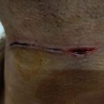 Lakhimpur - Lakhimpur Kheri News: चीनी मांझे की चपेट में आया युवक, गले में लगा गहरा कट