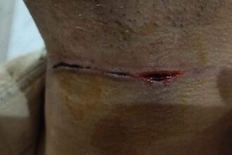 Lakhimpur - Lakhimpur Kheri News: चीनी मांझे की चपेट में आया युवक, गले में लगा गहरा कट