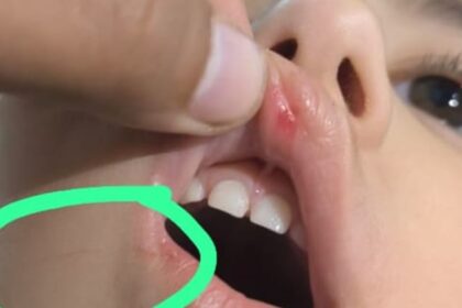 Bareilly - Bareilly News: स्कूल में रोई मासूम बच्ची तो टीचर ने कर दी पिटाई, चोट लगने से होंठ से निकला खून