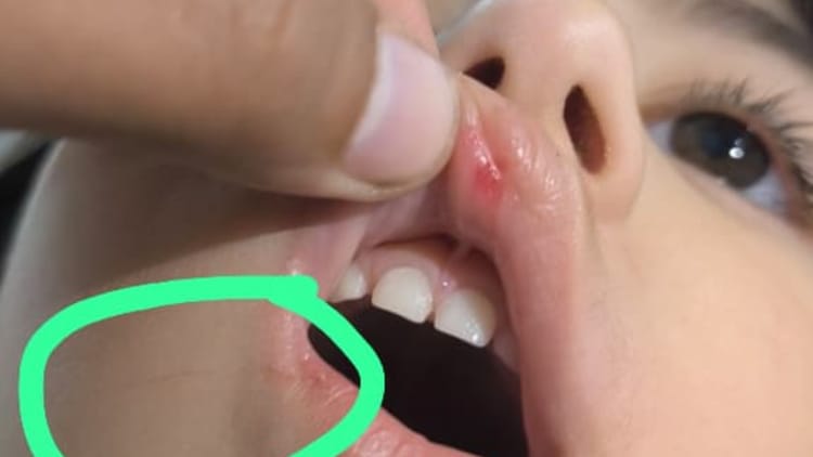 Bareilly - Bareilly News: स्कूल में रोई मासूम बच्ची तो टीचर ने कर दी पिटाई, चोट लगने से होंठ से निकला खून