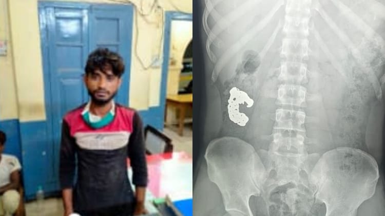 UP: बरेली - UP: बरेली में यक्ष एप से पकड़ा गया चोर, गिरफ्तार होते ही निगल गया चोरी का ब्रेसलेट; पुलिस ने कराया एक्सरे