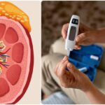 चिंताजनक: - चिंताजनक: हर चार में एक डायबिटिज रोगी को लिवर की बीमारी का भी खतरा; लगभग 70% मरीजों में मिले फैटी लिवर