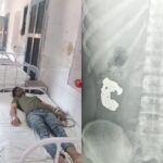 UP News: - UP News: बरेली में चोर ने निगला चांदी का ब्रेसलेट, पुलिस ने बरामदगी के लिए अपनाया ये तरीका