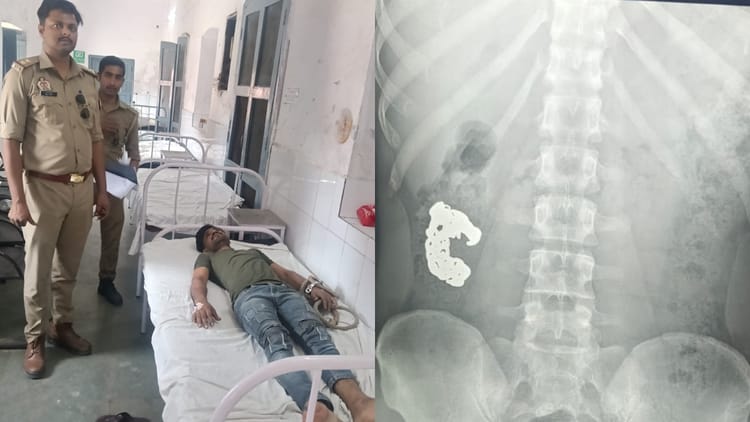 UP News: - UP News: बरेली में चोर ने निगला चांदी का ब्रेसलेट, पुलिस ने बरामदगी के लिए अपनाया ये तरीका